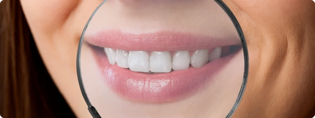 Traitement esthétique des taches dentaires SNT, Dentistes à Vaires-sur-Marne