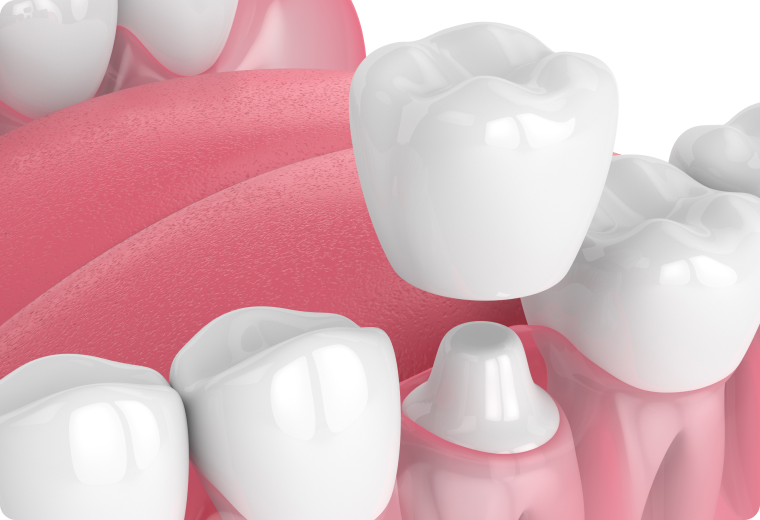 Couronnes dentaires SNT, Dentistes à Vaires-sur-Marne