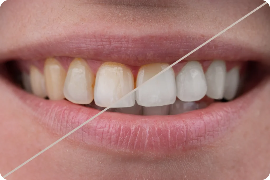 Éclaircissement dentaire SNT, Dentistes à Vaires-sur-Marne