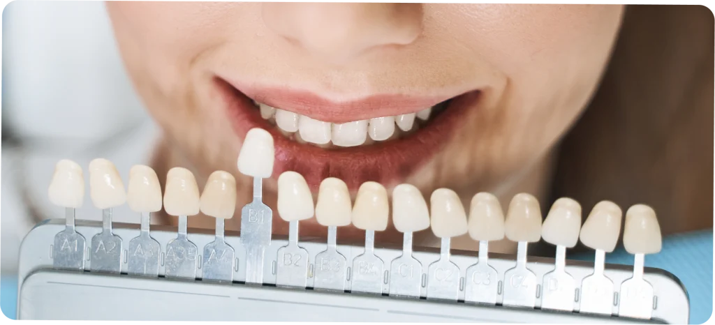 Facettes dentaires SNT, Dentistes à Vaires-sur-Marne