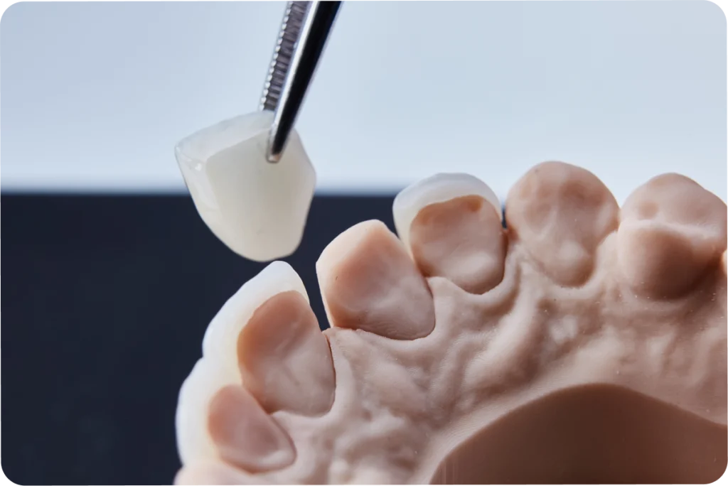 Facettes dentaires SNT, Dentistes à Vaires-sur-Marne
