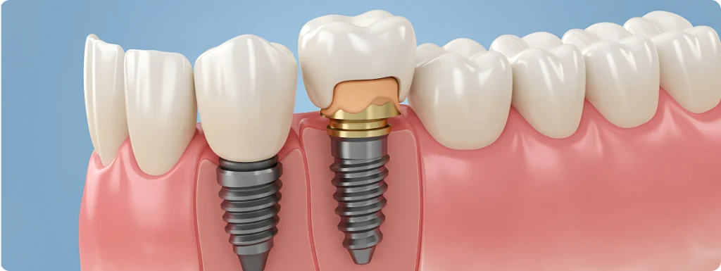 Implant dentaire SNT, Dentistes à Vaires-sur-Marne