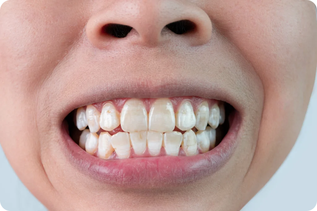 Traitement esthétique des taches dentaires SNT, Dentistes à Vaires-sur-Marne