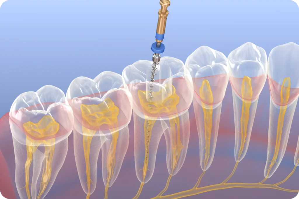 Traitement endodontique SNT, Dentistes à Vaires-sur-Marne