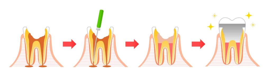 Traitement endodontique SNT, Dentistes à Vaires-sur-Marne