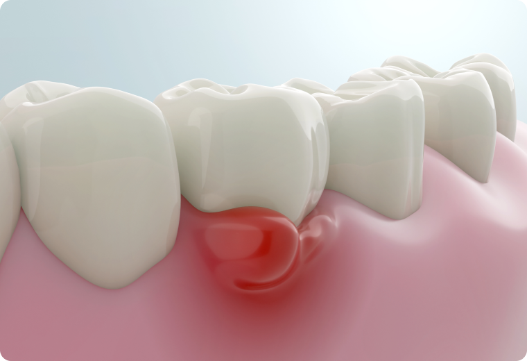 gencives saignent dentiste vaires sur marne Gencives qui saignent : que faire et quand consulter ? SNT, Dentistes à Vaires-sur-Marne
